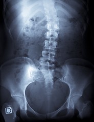 Image showing x-ray of a young female spine