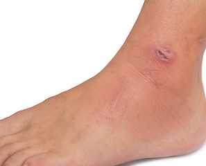 Image showing wound on foot