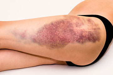 Image showing Bruise on wounded woman leg