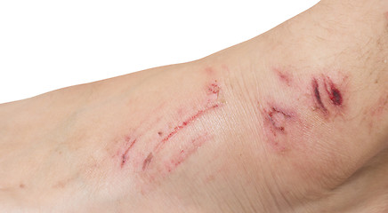 Image showing wound on a foot
