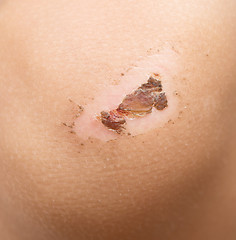 Image showing wound on baby knee