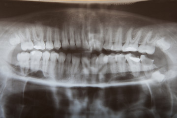 Image showing Radiograph teeth