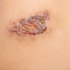 Image showing wound on skin