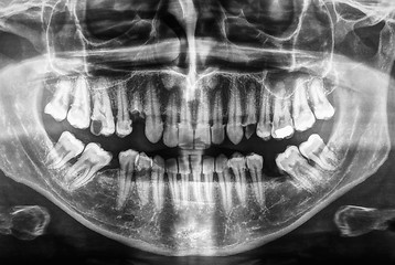 Image showing Human teeth xray in black and white