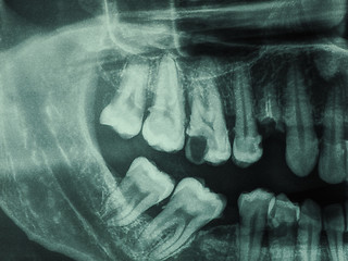 Image showing Human teeth xray
