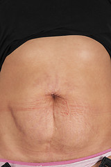 Image showing female belly with stretch marks