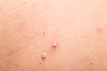 Image showing mole and pimple