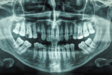 Image showing Human teeth xray