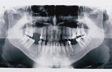 Image showing panoramic x-ray skan