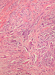 Image showing Breast Cancer