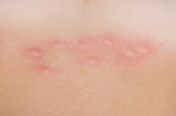Image showing mosquito bites on skin