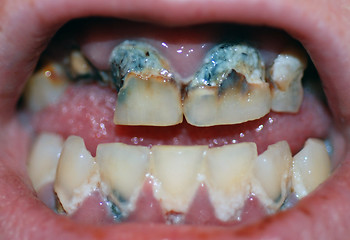 Image showing Severe Tooth Decay