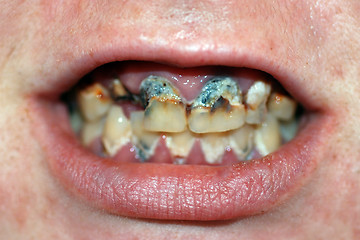 Image showing Mouth with Severe Tooth Decay