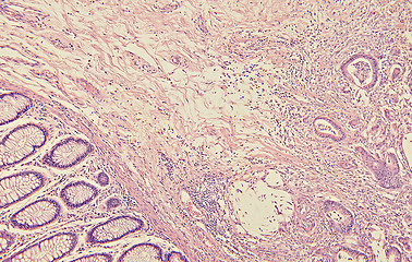 Image showing Colon Cancer Histology