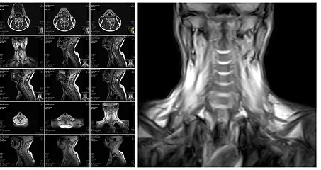 Image showing Magnetic resonance imaging of the cervical spine.