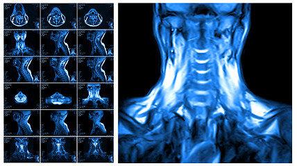 Image showing Magnetic resonance imaging of the cervical spine.