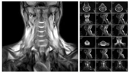 Image showing Magnetic resonance imaging of the cervical spine.