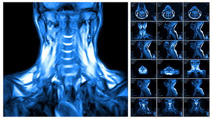 Image showing Magnetic resonance imaging of the cervical spine.