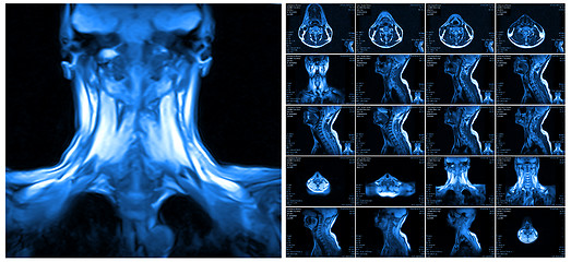 Image showing Magnetic resonance imaging of the cervical spine.