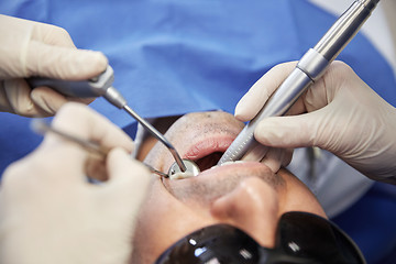 Image showing dentist hands treating male patient teeth