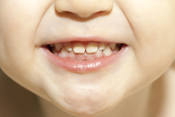 Image showing teeth with caries