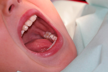 Image showing children teeth