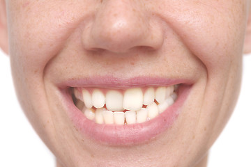 Image showing woman crooked teeth