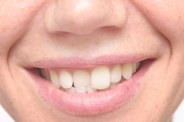 Image showing woman crooked teeth