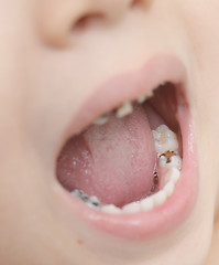 Image showing baby teeth with caries