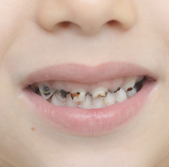 Image showing baby teeth with caries