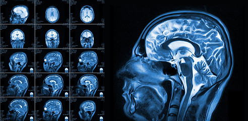 Image showing Magnetic resonance imaging of the brain
