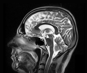 Image showing Magnetic resonance imaging of the brain