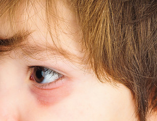 Image showing Pink eye on a boy child, at closeup with brown eye and brunette 