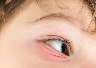 Image showing Pink eye on a boy child, at closeup with brown eye and brunette 