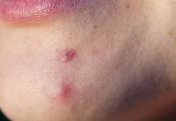 Image showing pimple on the chin