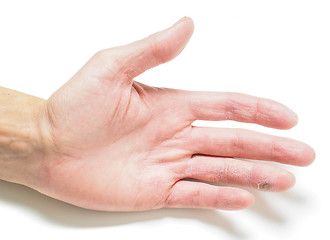 Image showing Finger with infected cut, on hand with dry skin, towards white w