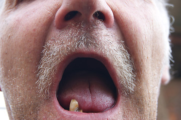 Image showing Mouth with rotten teeth