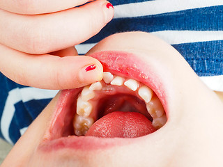 Image showing Closeup of finger feeling a lose tooth in a little girls mouth