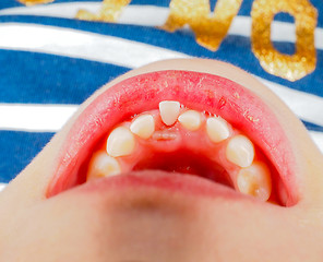 Image showing Closeup of lose tooth in a little girls mouth