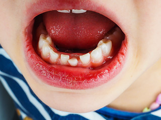 Image showing Closeup of lose tooth in a little girls mouth