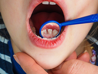 Image showing Little girl at the dentist examining a lose tooth with a dental 