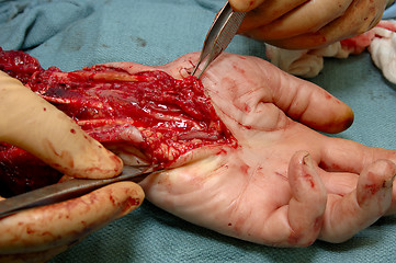 Image showing Hand Surgery 2