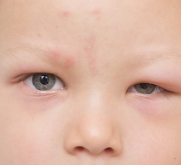 Image showing allergy after mosquitoes