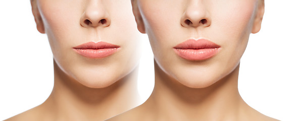 Image showing woman before and after lip fillers