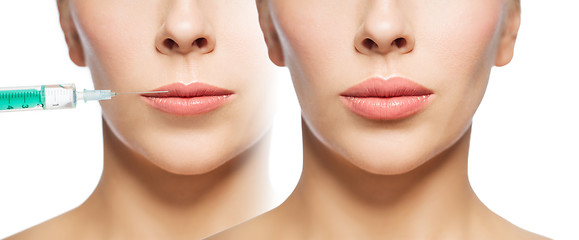 Image showing woman before and after lip fillers injection