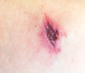 Image showing wound 
