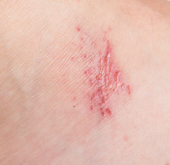 Image showing wound on skin