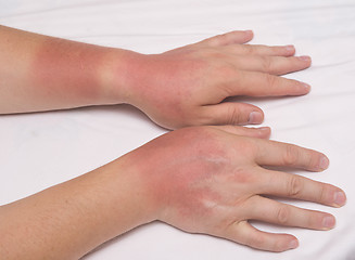 Image showing sunburn