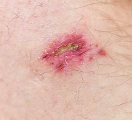 Image showing wound on skin