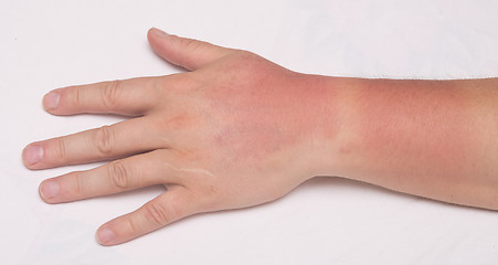 Image showing sunburn